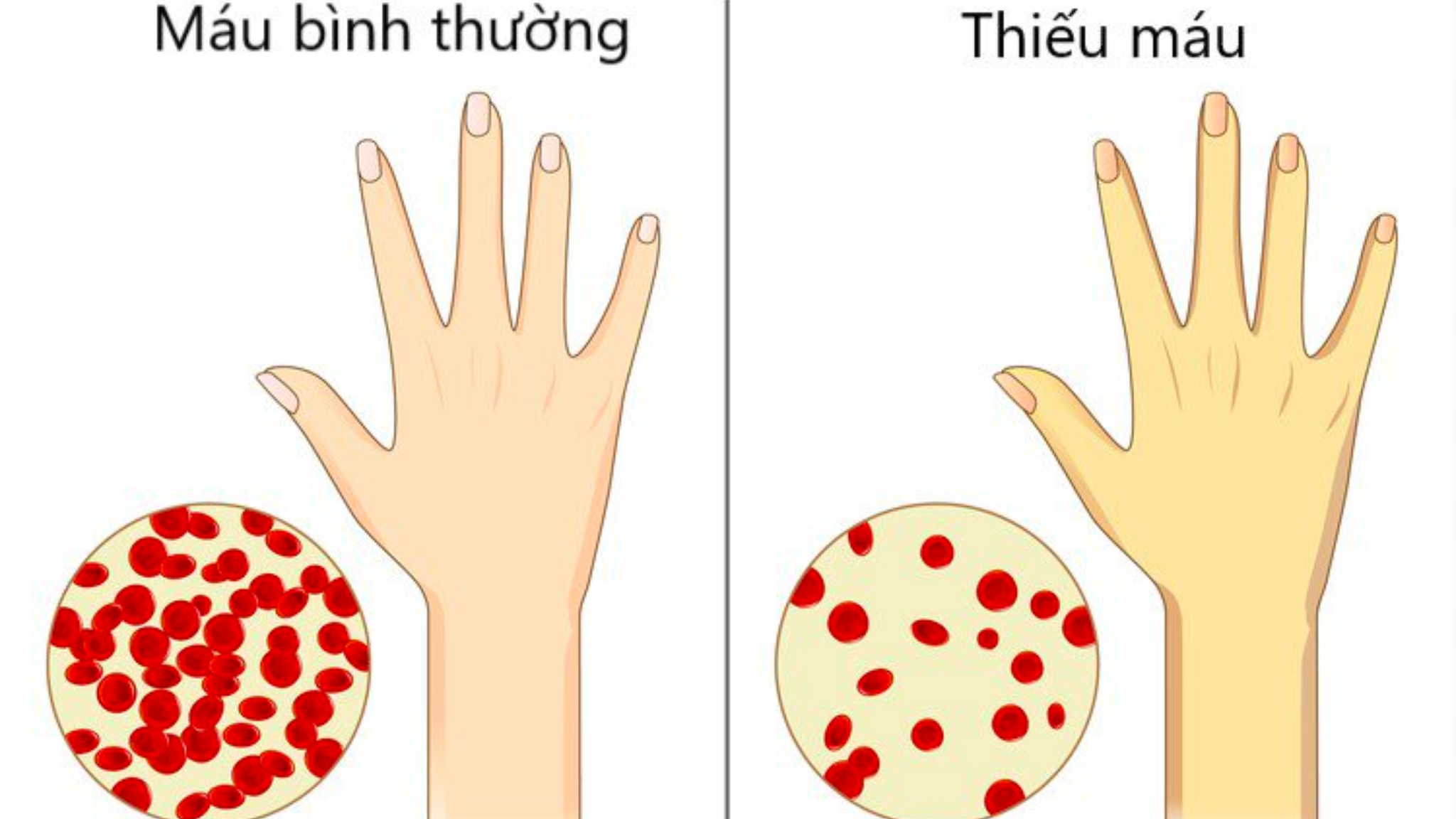 Thiếu máu do thiếu sắt? Nguyên nhân và cách điều trị tại nhà hiệu quả